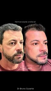 Perfilado De Mandibula Santa Cruz