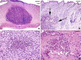 Image result for chancroid