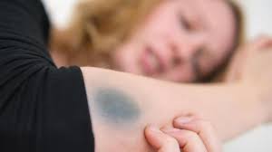 Hamatome Wann Sie Mit Einem Blauen Fleck Zum Arzt Gehen Sollten Augsburger Allgemeine