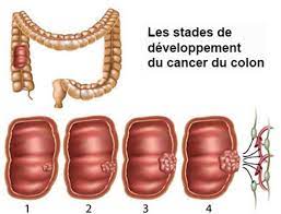 The disease affects slightly more men. Cancer Du Colon Cancer Colorectal Symptomes Traitement Definition Docteurclic Com