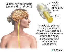Scleroza multiplă ar trebui să fie suspectată atunci când nevrită optică, oftalmoplegia internucleară si alte simptome compatibile cu scleroza multiplă, în special în. Scleroza Multipla Simptome Drbendo Ro