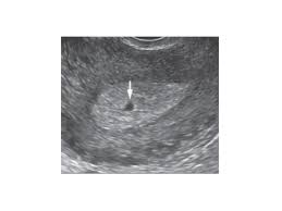 Image result for First Trimester Ultrasound