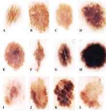 Melanoma symptoms often first appear as changes to a current mole. Early Melanoma Detection Nonuniform Dermoscopic Features And Growth Journal Of The American Academy Of Dermatology