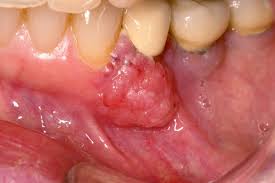 Image result for spinocellular carcinoma of the oral cavity