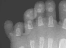 In middle english, it's the little man. Polydactyly Symptoms Causes And Treatments