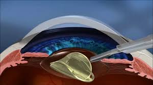 Image result for Cataract Extraction