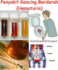 Tidak melulu kencing berdarah terjadi pada wanita yang sedang menstruasi. Kencing Berdarah Adakah Salah Satu Tanda Sakit Buah Pinggang Sinar Hidup Sihat