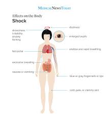 Shock Signs Symptoms And What To Do