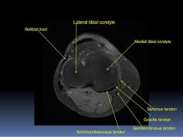 When the muscle contracts, the tendons are pulled, and the bone is moved. Mri Knee Joint Anatomy