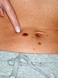 When a hair follicle becomes blocked, it is referred to as an ingrown hair. What Is That Skin Growth Skin And Beauty Center Everyday Health