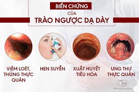 Đây là một trong những phương pháp chữa trào ngược dạ dày tại nhà đang được nhiều bệnh nhân cho phản hồi. Bai Thuá»'c Trao NgÆ°á»£c Dáº¡ Day Chá»¯a Bá»‡nh Dá»©t Ä'iá»ƒm Khá»i Toan Diá»‡n Tin Tá»©c Má»›i Nháº¥t 24h Ä'á»c Bao Lao Ä'á»™ng Online Laodong Vn