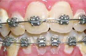 How to brush your teeth with braces rinse off your toothbrush and apply your favorite toothpaste. Life With Braces