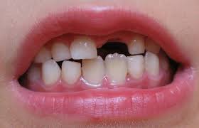 Image result for Tooth Avulsion