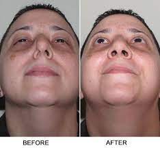 The Healthy Sinus Fact Vs Fiction Dr Garrett Bennett Ny Sinus Rhinoplasty Surgeon Rhinoplasty Sinus Health Nostril Reduction