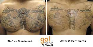 After 2 Laser Tattoo Removal Treatments We Have Great Progress On This Chest Piece Removal Shading Typical F Laser Tattoo Tattoo Removal Laser Tattoo Removal