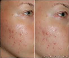 Maybe you would like to learn more about one of these? áƒ¦áƒ¦áƒ¦ A Famous Foaming Gel Effaclar By La Roche Posay How Was It To Use The Product How To Lather It Better And How Did The P Gel Cleanser Skin La Roche