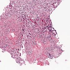 Differential diagnosis between herpes simplex virus (hsv) esophagitis and cytomegalovirus (cmv) esophagitis is challenging because there are many similarities and overlaps between their. Pin On Esophagus