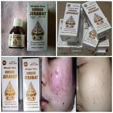 Agen Minyak Cap Wayang Khusus Jerawat 0813 1819 7899 Jerawat Produk Perawatan Kulit Alami Obat Jerawat
