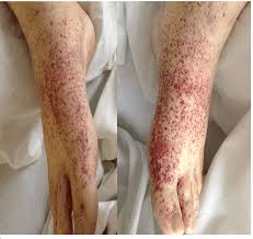 Purpura, petechiae, or ulcers may develop. Right And Left Foot And Ankle Showing Petechial And Purpuric Skin Rash Download Scientific Diagram
