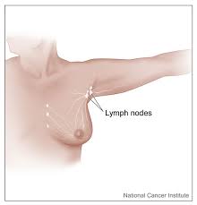 Video have different signs of breast cancer like to do a visual bse, get comfortable with your breasts, look for swelling and get a clinical breast exam etc. Understanding Lymphedema Related To Breast Cancer