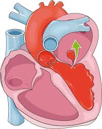 Mitral valve regurgitation is the name for one of those times when your blood isn't going where it should. Mitral Regurgitation Archives Servier Medical Art