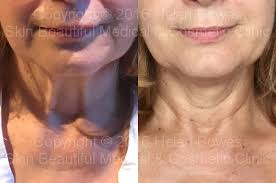 Thread lift before and after uk. Pdo Thread Neck Lift Exeter Bristol Coventry Milton Keynes Bournemouth