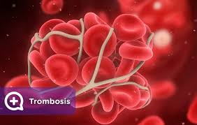 Arterial thrombosis is a blood clot in an artery, which can be very serious because it can stop blood arteries are blood vessels that carry blood from the heart to the rest of the body and the heart muscle. Que Es Una Trombosis Trunk Y Que Futbolistas Solfa Syllable Han Sufrido Que Es Una Trombosis Arterial