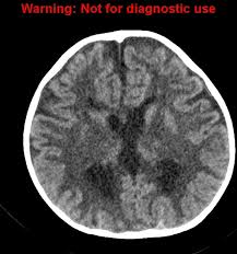 Molecular biology of maple syrup urine disease. Maple Syrup Urine Disease Radiology Case Radiopaedia Org