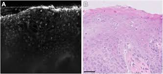Scattering-Based Light-Sheet Microscopy Imaging of Human  Papillomavirus–Associated Squamous Lesions of the Anal Canal: A  Proof-of-Principle Study