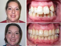 Invisalign is an orthodontic system that uses aligners to straighten the teeth. Can Invisalign Fix Overbites And Other Bite Problems Premier Orthodontics