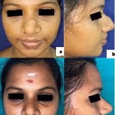 PDF) Schwannoma of the Nose at the Keystone Area in Relation to the Dorsal  Nasal Nerve