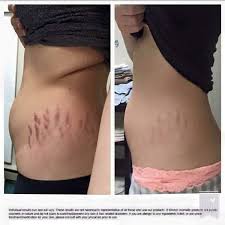 Pin On Stretch Marks On Bum