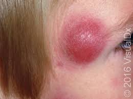 Image result for sores on the head in children