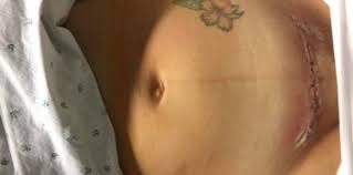 What S Normal For A C Section Scar All Your Questions Answered Theasianparent