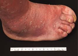 Acute Presentation Of Arthritis Mutilans The Journal Of Rheumatology