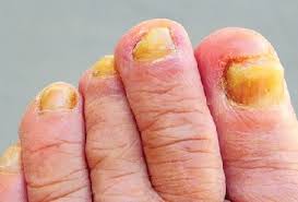Image result for Yellow nail syndrome feet