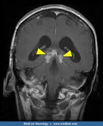 Image result for Cryptococcal Meningitis