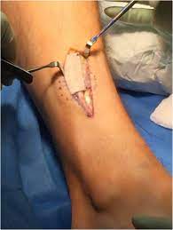 Bilateral Non Traumatic Lower Leg Fascial Defects Causing Peroneal Muscle Herniation And Novel Use Of A Graftjacket To Repair The Fascial Defect Sciencedirect