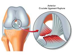 Are you ever the same after an acl surgery? Anterior Cruciate Ligament Acl Tear