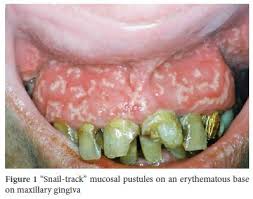 View Of Pyostomatitis Vegetans Leading To Crohn S Disease Diagnosis Annals Of Gastroenterology