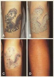 Laser Tattoo Removal Remocao De Tatuagem Tattoo Delicada Tatuagem