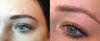 Saline tattoo removal demonstration!watch as i show how to remove microblading with saline tattoo removal! Removal Lightening Treatment