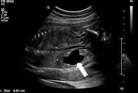 Sonographic Diagnosis Of Fetal Uropathy Iame
