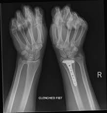 Image result for Wrist XRay