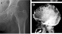 Appendicular metastatic prostate cancer simulating osteosarcoma, Paget's  disease, and Paget's sarcoma