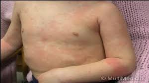 History and examination are adequate to make a diagnosis in children > 36 months who are otherwise well and. The Dos And Don Ts Of Fighting A Fever Parents