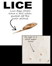 Lice Vs Dandruff 7 Differences Between Lice Eggs And Dandruff In 2020 Lice Eggs Louse Dandruff