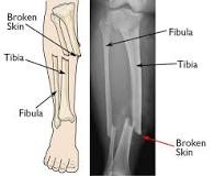 Image result for fractures simple,complex and compund