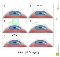 Lasik Eye Surgery Procedure Steps Of Lasik Eye Surgery Procedure Eps10 Sponsored Ad Advertisement Eye S Eye Surgery Laser Eye Surgery Lasik Surgery