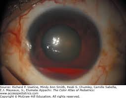 Image result for Hyphema